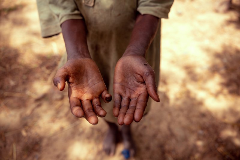 Nasiru&#x27;s hands are becoming increasingly disabled without leprosy treatment.JPG